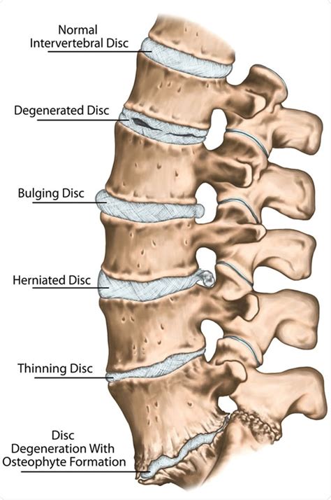 Degenerative Disc Disease Treatment and Self-Care – Regenerative ...