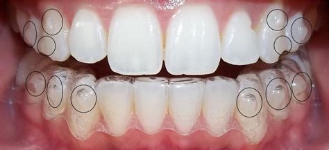 My Invisalign Journey (5): Attachments and Quick Update | Ortodoncia ...