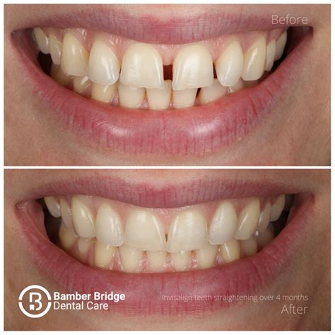 Orthodontics (Teeth Straightening) Preston - Bamber Bridge Dental