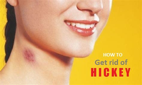 Get Rid of Hickeys on Neck, Lips, Chest Fast Overnight