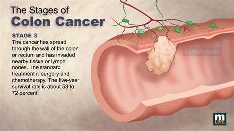 Stages of Colon Cancer - YouTube