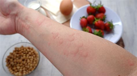 Diet and Atopic Dermatitis - The Dermatology Digest