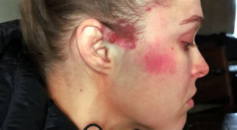 WWE News: Ronda Rousey shows off gruesome injury sustained at Survivor ...