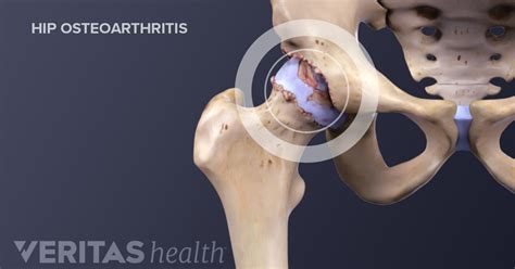 What Is Hip Osteoarthritis?