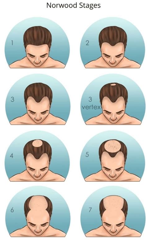 How To Tell If You Have A Receding Hairline