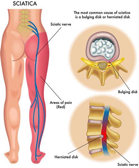 Lower Back Pain Treatment NYC | Lower Back Pain Doctors Specialists