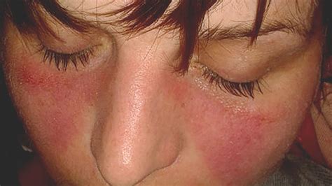 Lupus Rash vs. Rosacea: What’s Causing My Butterfly Rash?