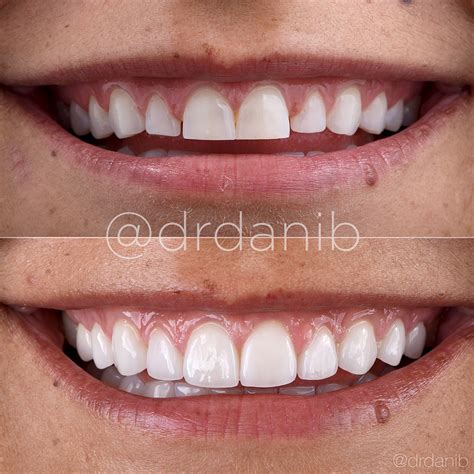 Teeth Veneers Before And After