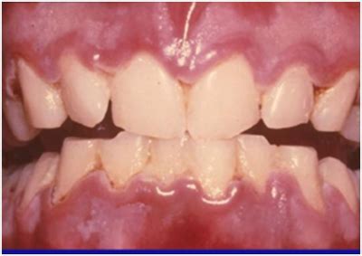 Linear Gingival Erythema