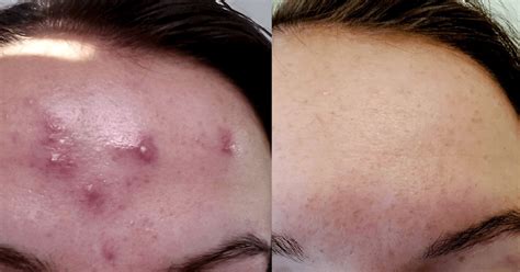 Hormonal acne treatment: Clear skin in 4 months