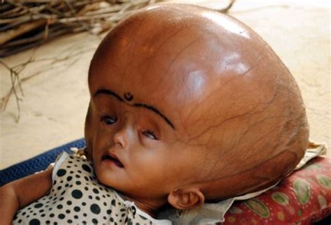 Tragic Indian Baby's Head Swells Up to Huge Size [PICTURE] | IBTimes UK