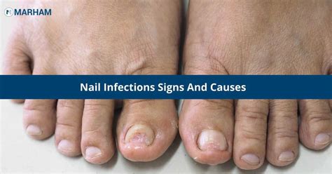 Nail Infections: Know The 11 Signs And Causes! | Marham