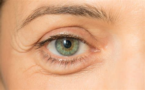 Puffy Eyes: Triggers, Treatments & Foods To Eat/Avoid – SkinKraft