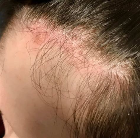 List 94+ Pictures Show Pictures Of Scalp Psoriasis Stunning