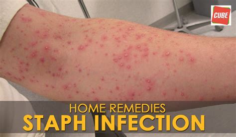 Fastest way to cure staph infection