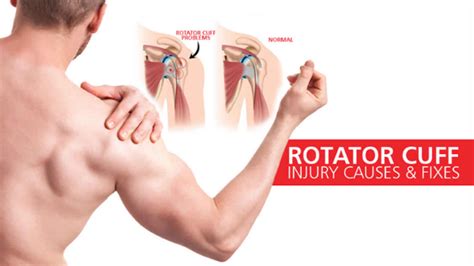 Rotator Cuff Injury Including Rotator Cuff Tear, Rotator Cuff Bursitis ...