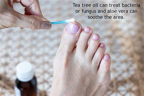 Foot Rashes: Causes, Treatment & Home Remedies