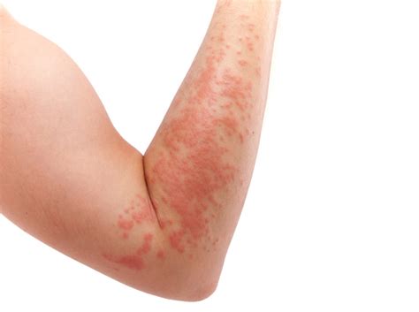 What Are Chronic Hives? - Health - Health Journal