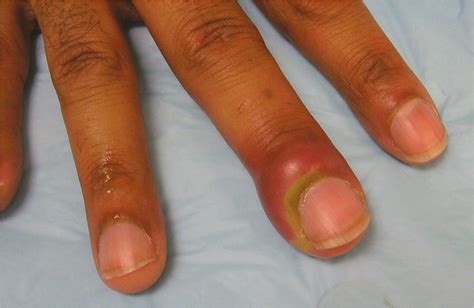 Staph Infection Fingernail