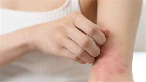 Heat rash treatment: Try the cooling benefits of coconut oil | HealthShots