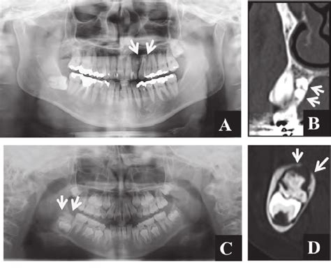 Panoramic radiograph image (A) and oblique sagittal CT image (B) of ...