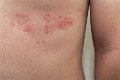 What is Shingles?