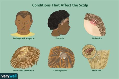 Scalp Conditions: Causes, Treatment, and Pictures