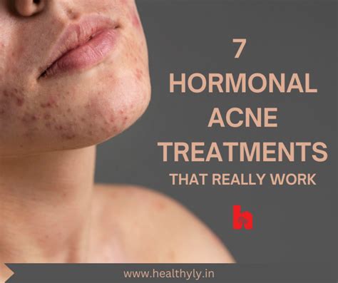 7 Tried & Tested Hormonal Acne Treatments That Really Work