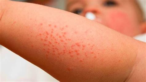 What Does Sun Allergy Rash Look Like? See These Pictures