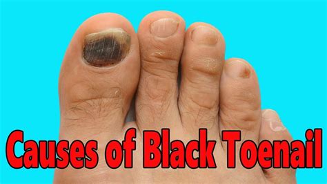 Diabetes Black Toenail Fungus - DiabetesWalls