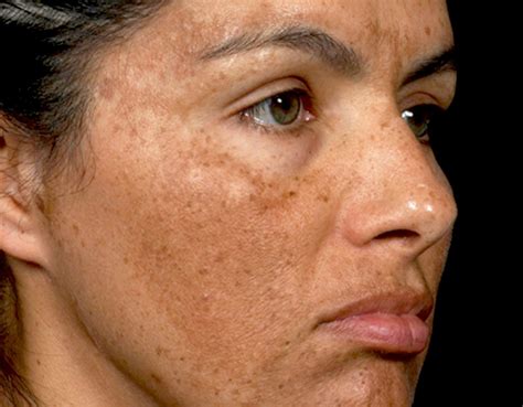 Your Guide to Melasma: How To Treat Tricky Dark Spots - Dr. Pimple Popper