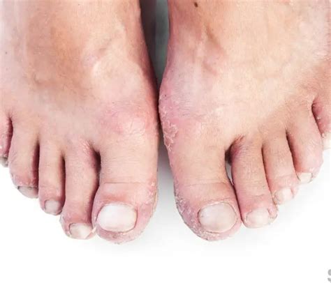 Skin Rashes On Feet