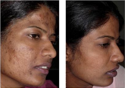 Laser Treatment For Dark Spots On Black Skin : Removing Dark Spots From ...