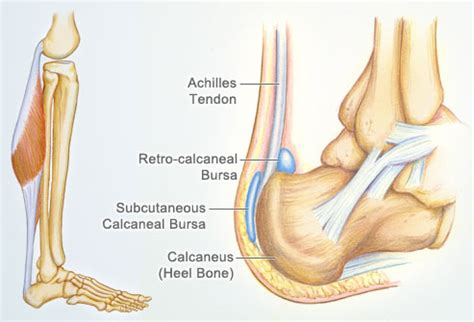 Subcutaneous Calcaneal Bursitis - Ankle, Foot and Orthotic Centre