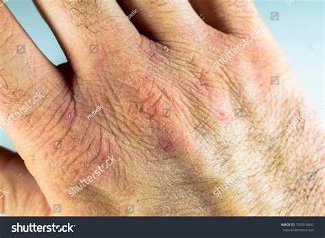 Close View Dry Cracked Hand Knuckles Stock Photo 793316842 | Shutterstock