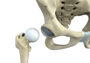 Hip Dislocation Surgery St. Louis, MO | Hip Dislocation Treatment St ...