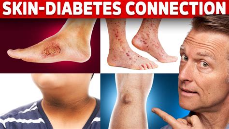 9 Diabetic Skin Problems That Indicate Diabetes - Gadico | Modern ...