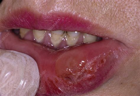 Syphilis Chancre Tongue