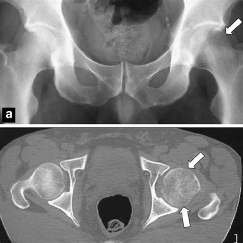 (PDF) Bone marrow edema syndrome