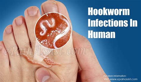 Hookworm Infections In Human | Infections, Parasite, Human