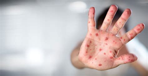 MMR (measles, mumps and rubella) vaccination | Health Plus Pharmacy