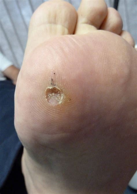 what cause plantar wart - pictures, photos