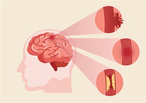 Different Types Of Strokes