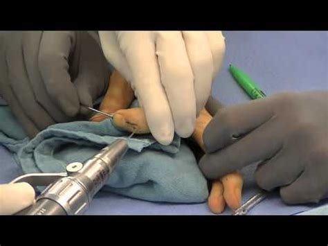 Mallet Finger Surgery Preformed by Dr. Thomas Trumble - YouTube