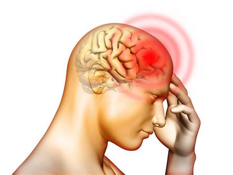 Is Migraine a Vascular Headache? - Migraine Canada™