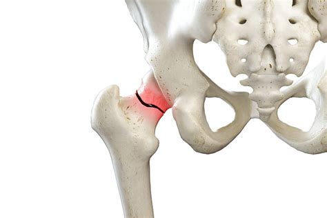 Should you repair a fractured hip or replace a fractured hip?