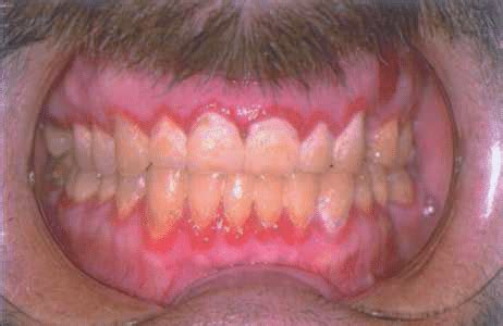 Linear gingival erythema showing the ribbon-like, red band ...