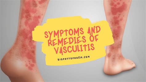 Vasculitis Symptoms