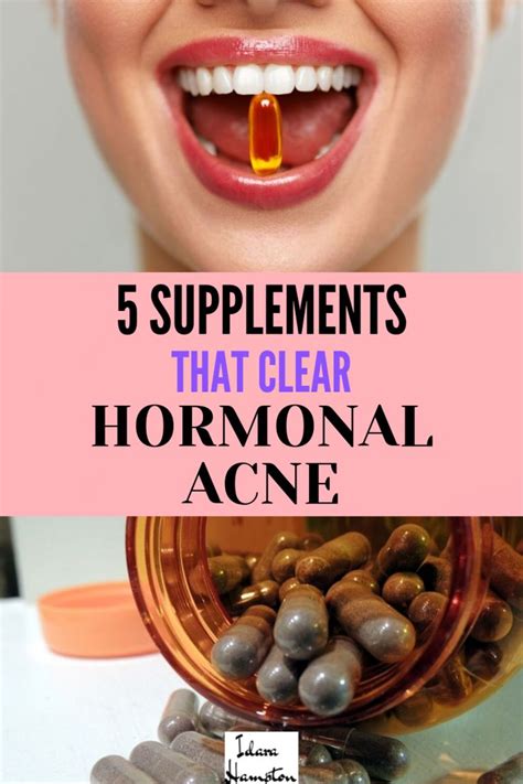 Is hormonal acne driving you crazy? I'm going to share five of my ...