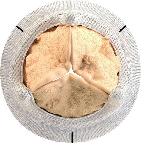 Aortic-Bioprosthetic-Valve -topview-calcification - Heart Valve Choice